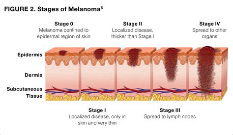 melanoma stages explained